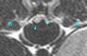 [T11-12横断像、T2強調画像]
