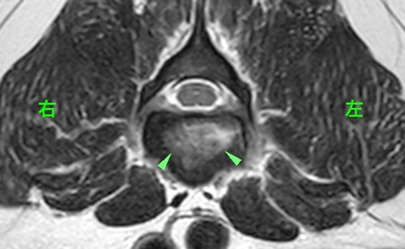 【MRI、L3病変部横断像、T2強調画像】