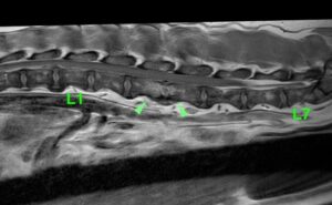 【MRI、腰部矢状断像、造影T1強調画像】