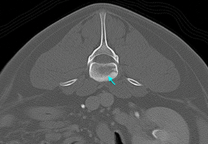 【CT、L3病変部横断像、骨条件】