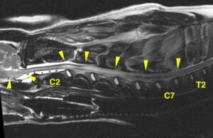 【MRI、頚部矢状断像、T2強調画像】