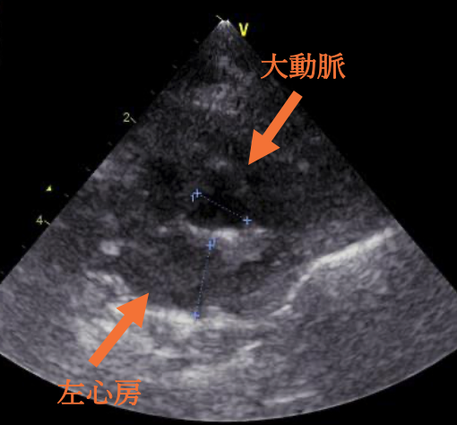 ⼼臓超⾳波検査結果