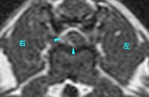 【MRI、T13-L1横断像、造影T1強調画像】