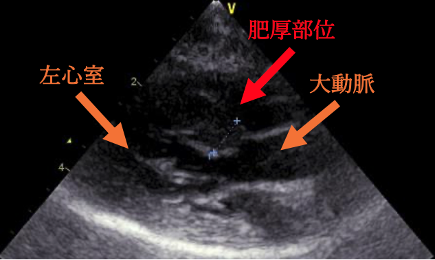 ⼼臓超⾳波検査結果