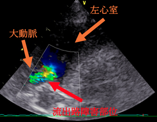 ⼼臓超⾳波検査結果