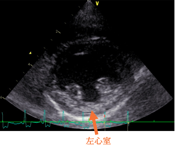 心臓超音波検査結果