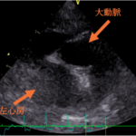 心臓超音波検査結果