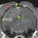 【MRI、横断像、造影T1強調画像】
