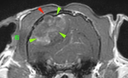【MRI、横断像、造影T1強調画像】