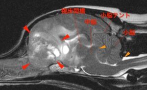 【MRI、矢状断像、T2強調画像、脳圧亢進時】