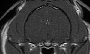 【MRI、横断像、造影T1強調画像】