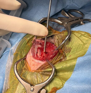 【手術中写真】