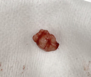 【摘出した腫瘍】