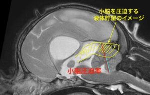 四丘体槽部の嚢胞状液体貯留